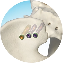 Lateral Approach