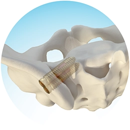 Posterior Lateral to Medial
