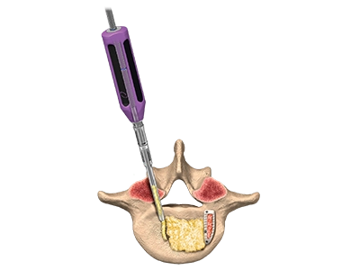 Graft Delivery System
