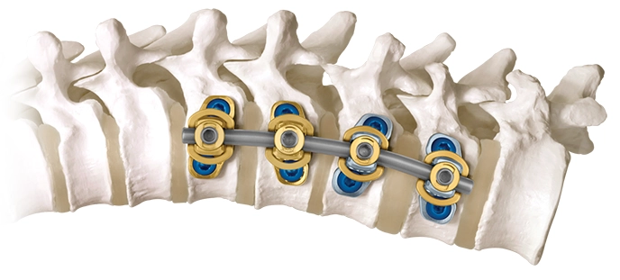 REVERE Anterior Integrated Staple System