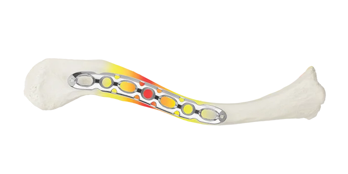 ANTHEM Clavicle