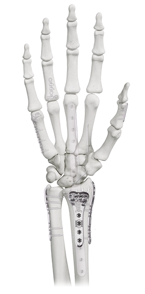ANTHEM Distal Radius