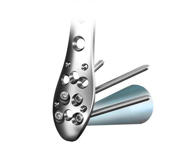 ANTHEM Distal Tibia