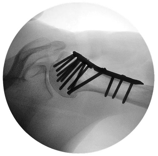 ANTHEM Proximal Humerus fluoro