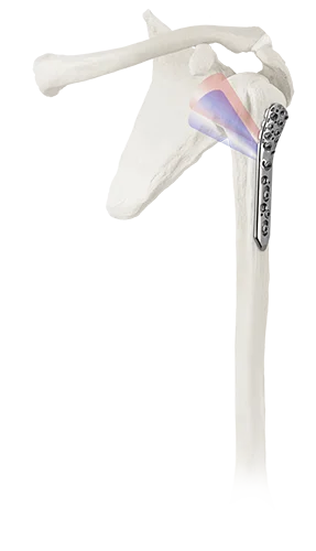 ANTHEM Proximal Humerus