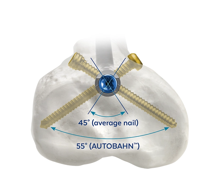 AUTOBAHN Tibial Nailing System
