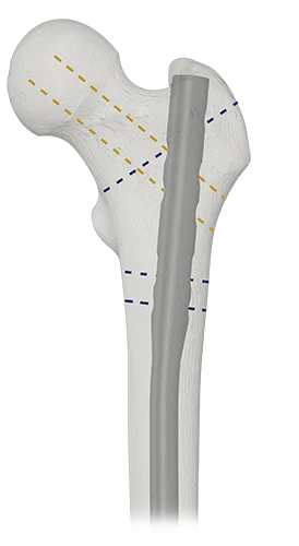 AUTOBAHN EVO Antegrade proximal locking options