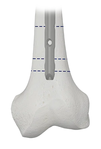 AUTOBAHN EVO Antegrade distal locking options