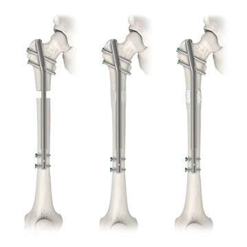Precice Limb Lengthening system