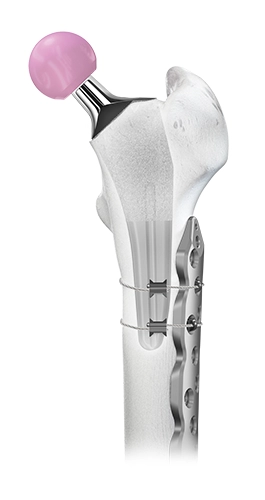 Distal Femur and Stretto