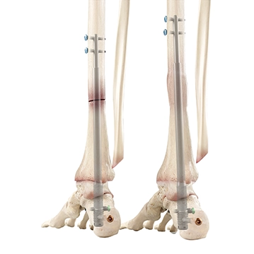 Precice Ankle Salvage System