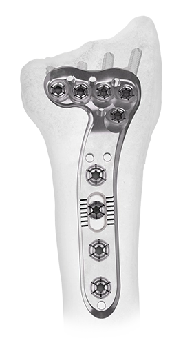 ANTHEM Distal Radius plate