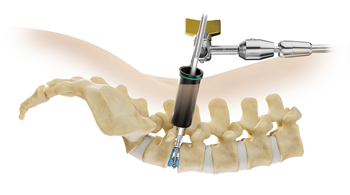 NuVasive Tube System