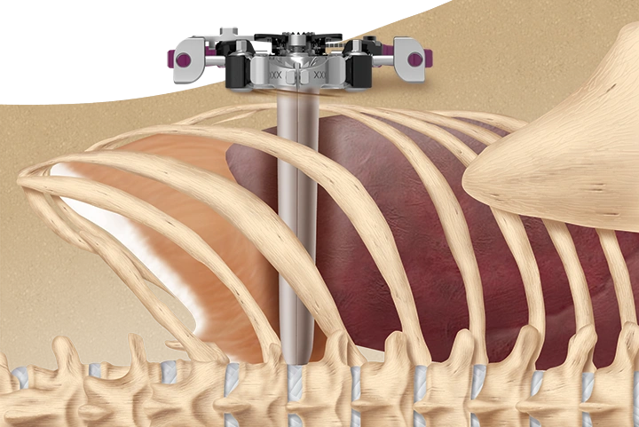 XLIF Thoracic