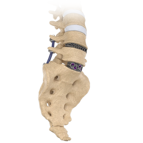XLIF Single Position Surgery