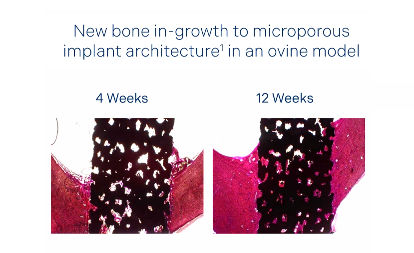 Modulus bone in-growth